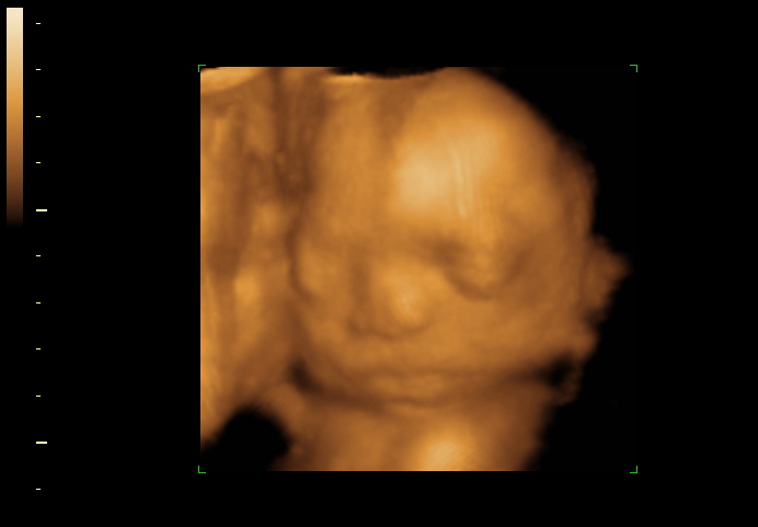 3D ultrasound image at 23 weeks